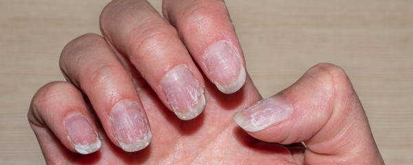 Ongles abîmés, cassants et/ou dédoublés : quels soins réparateurs naturels pour retrouver des ongles forts et en bonne santé ?
