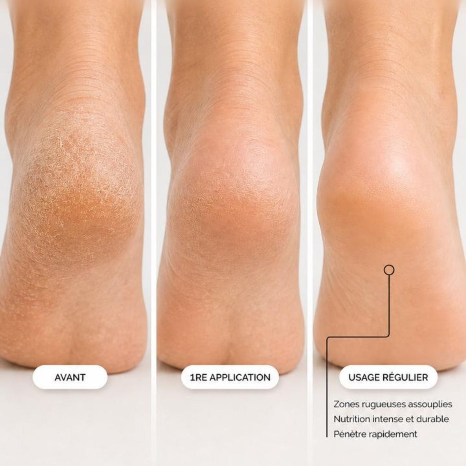 Onguent Pieds Secs et Callosités